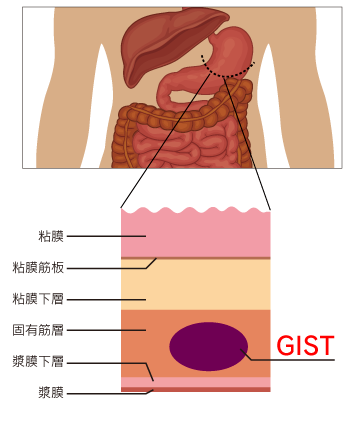 消化管間質腫瘍 Gist 関連抗体 Mblライフサイエンス